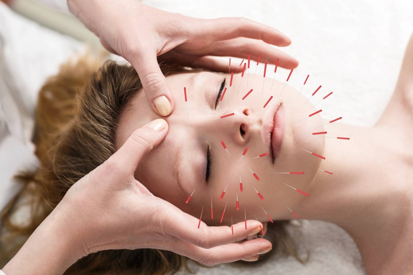 Akupunktura w leczeniu bólu głowy. Jakie są przyczyny bólu głowy wg medycyny chińskiej? Zbliżenie na twarz kobiety z wbitymi w nią igłami akupunkturowymi.