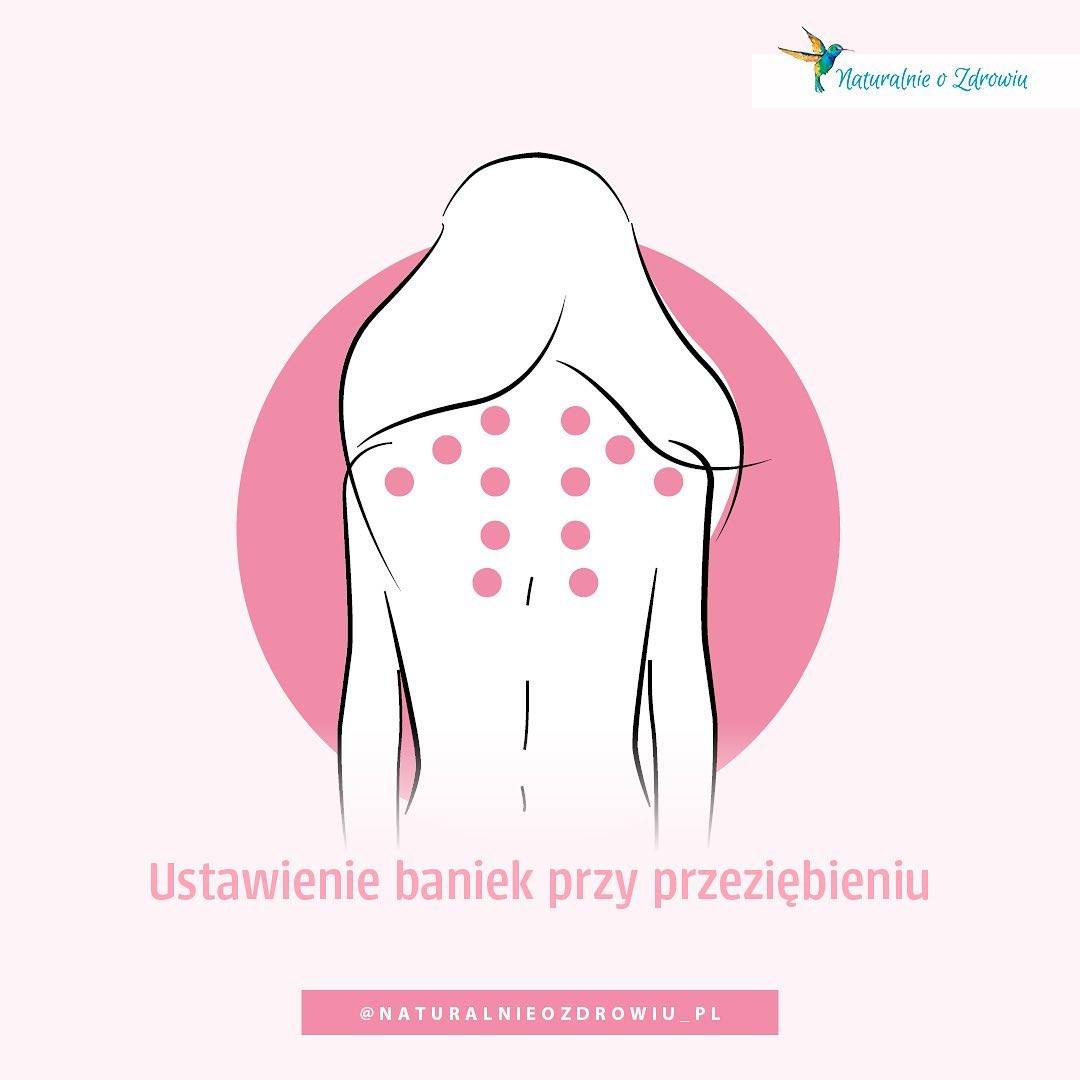 Gdzie i jak stawiać bańki na ciele przy przeziębieniu? Infografika.