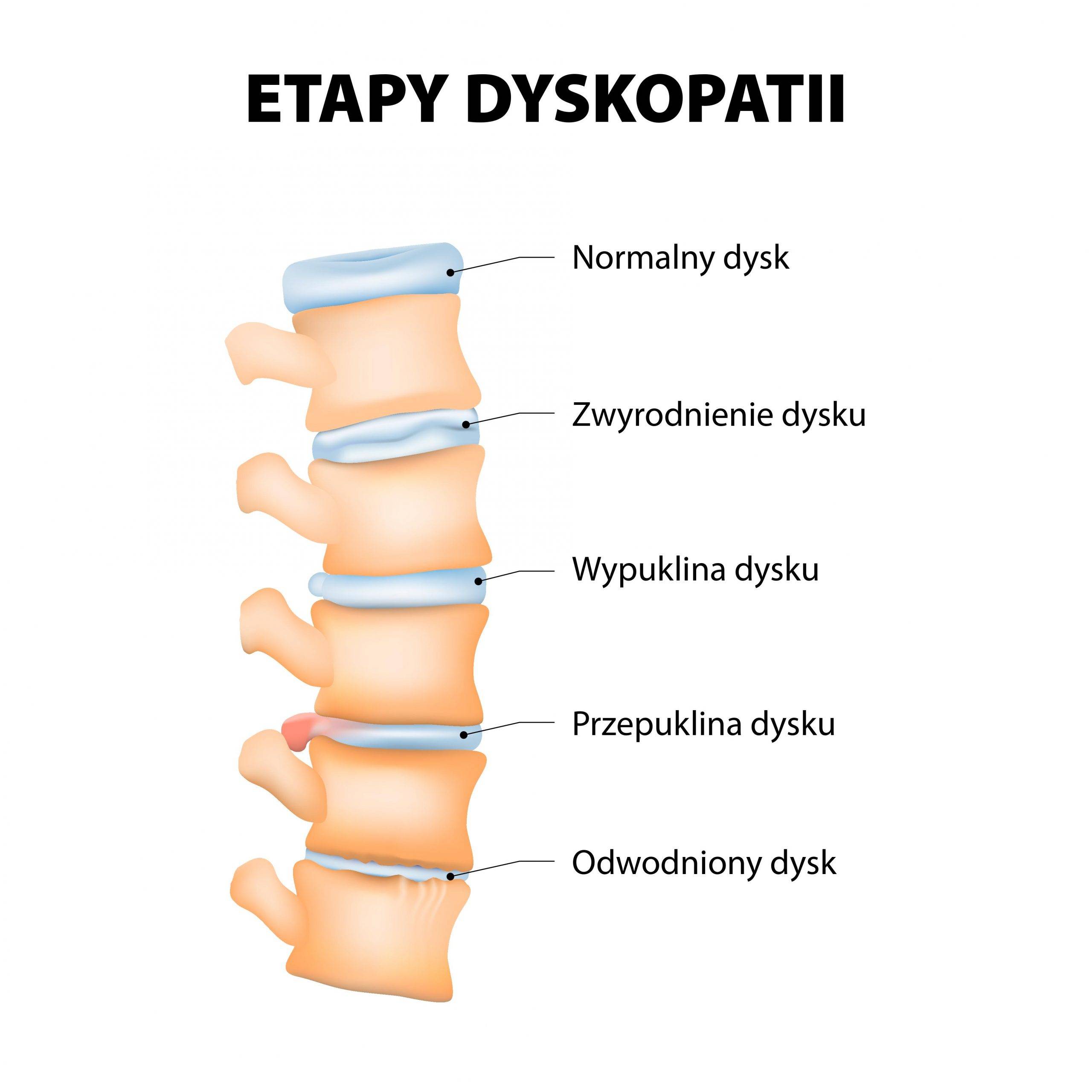 Etapy dyskopatii kręgosłupa - infografika.