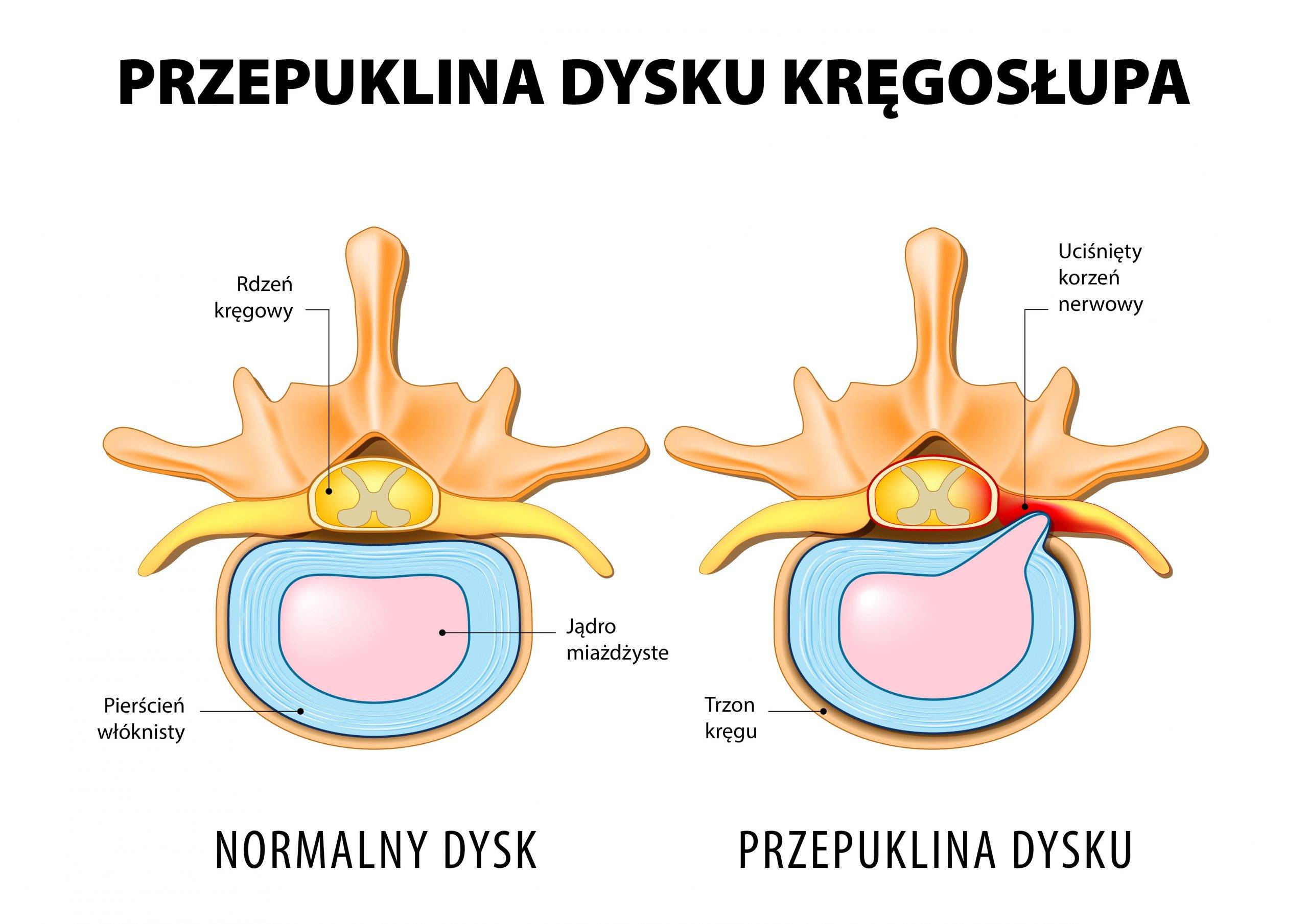 Przepuklina dysku kręgosłupa - infografika.