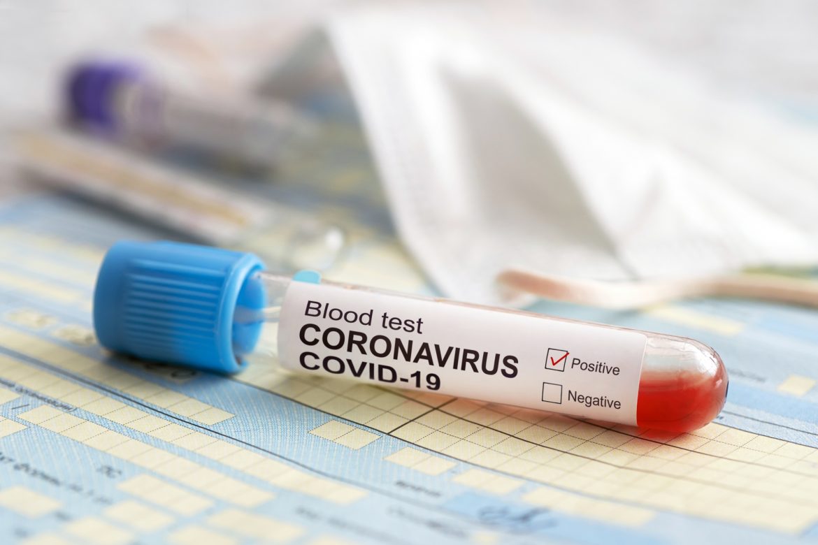 Test na koronawirusa - kiedy można go wykonać?