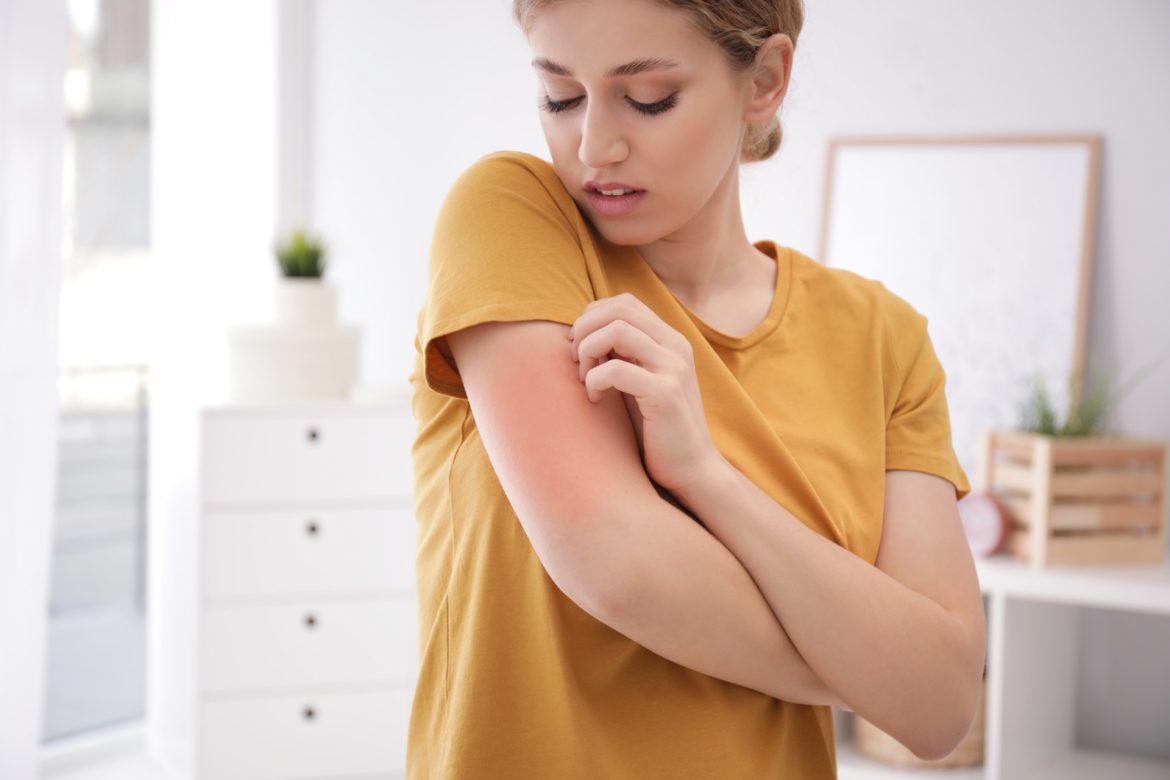 Użądlenie osy lub pszczoły. Jak reagować na wstrząs anafilaktyczny? Kobieta w żółtej bluzce drapie się w ramię po ukąszeniu przez owada.